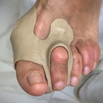 Изготовление ортеза