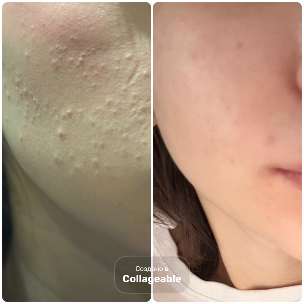 Комбинированная чистка лица