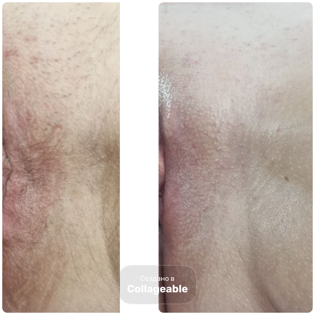 Интимное отбеливание