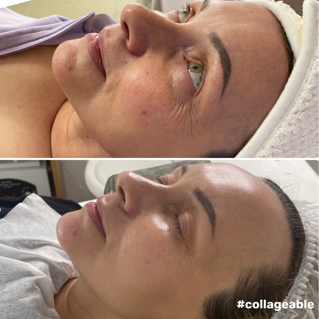 Кислородное Преображение лица