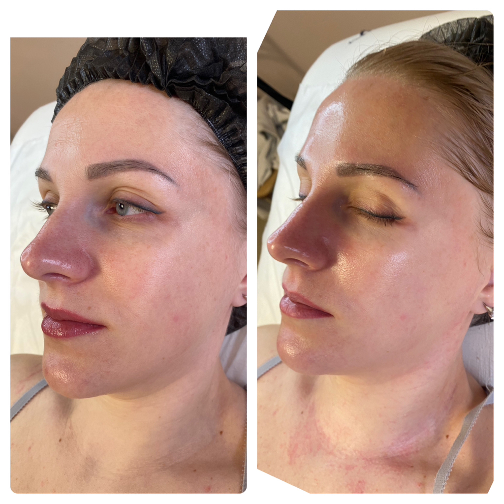 Процедура для лица «-10лет за час»