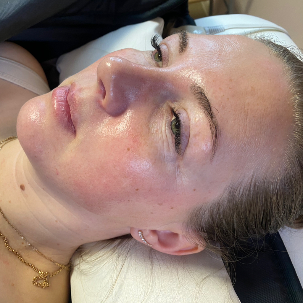 Миндальный пилинг