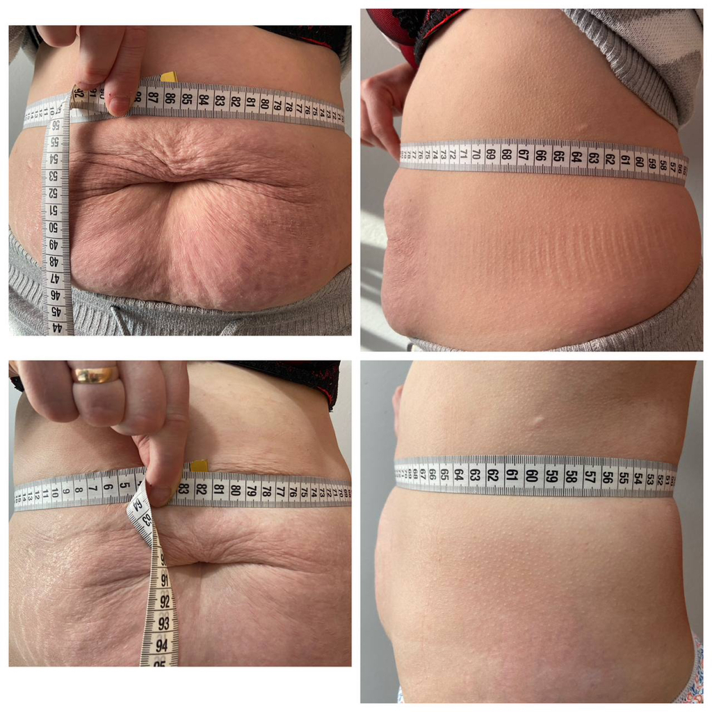 Процедура «Тонкая талия»