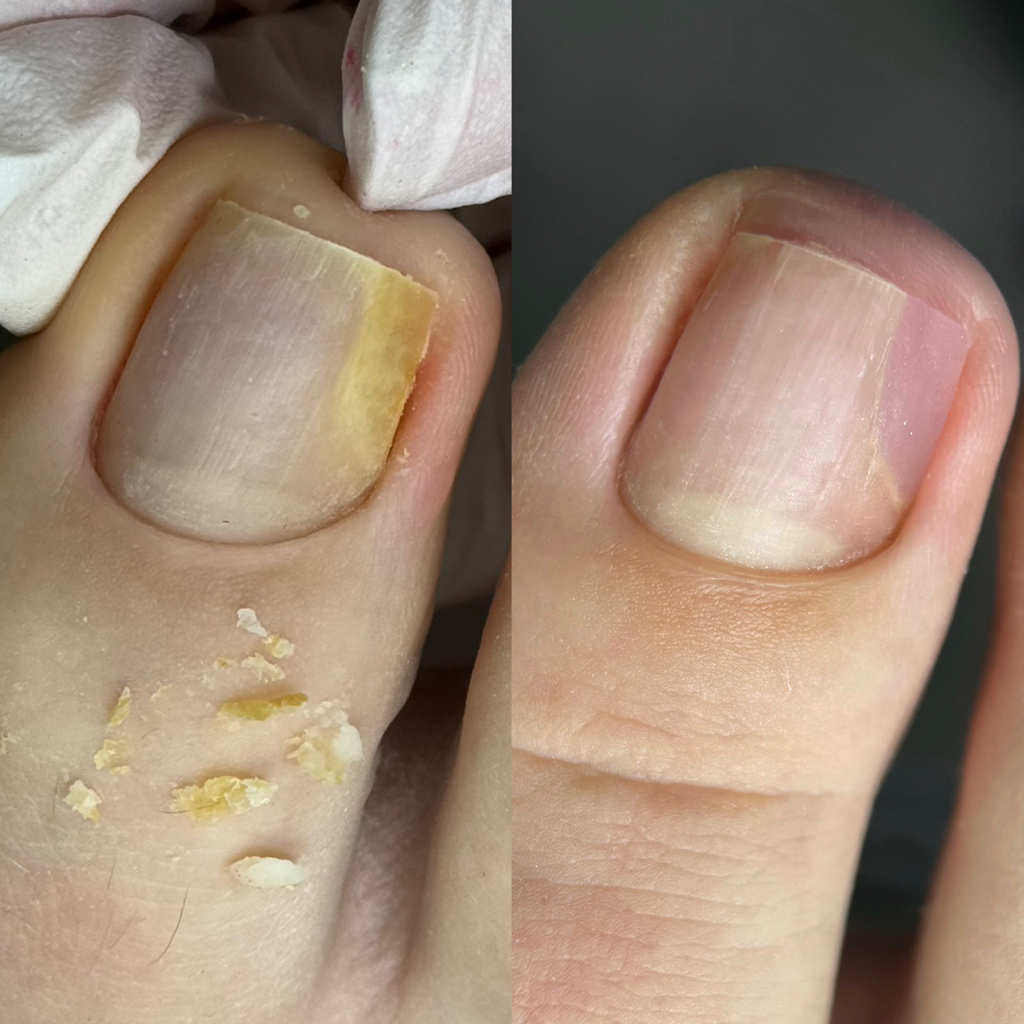 Протезирование  (зачистка ногтя,протезирование)