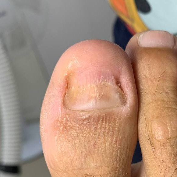 Зачистка одной ногтевой пластины (  большой пальц ног)