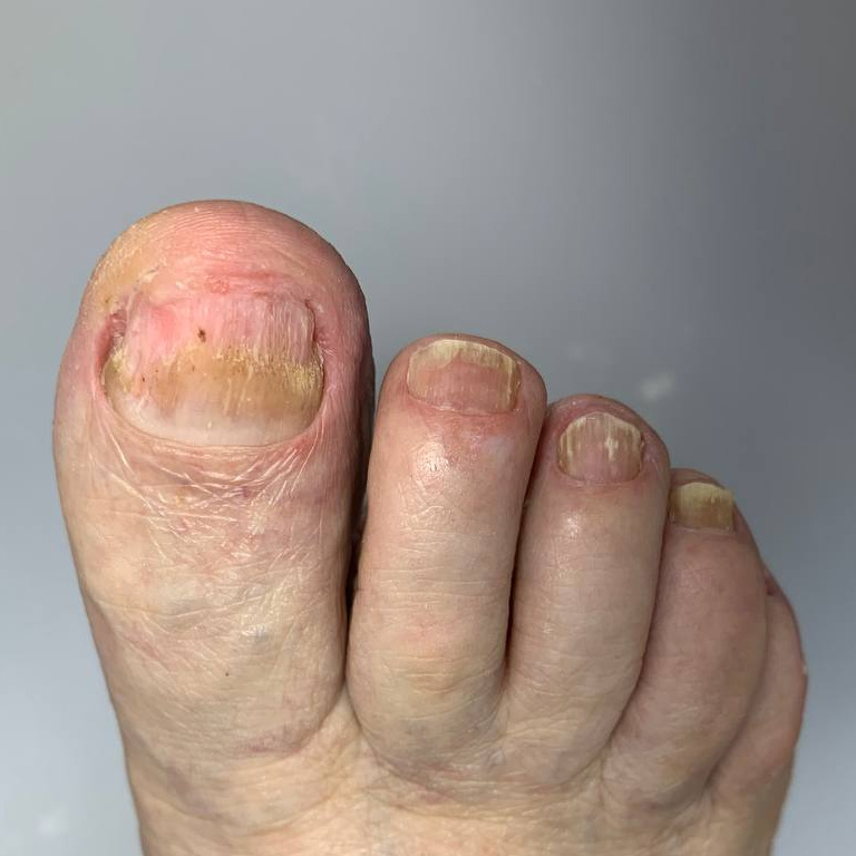 Подологический педикюр с зачисткой пальчиков