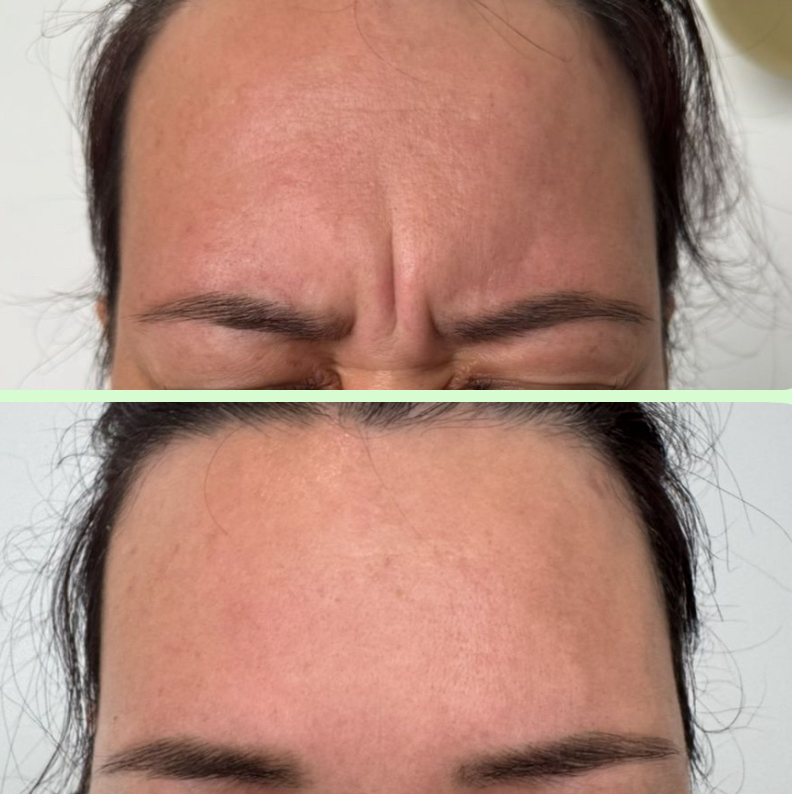 Ботулинотерапия