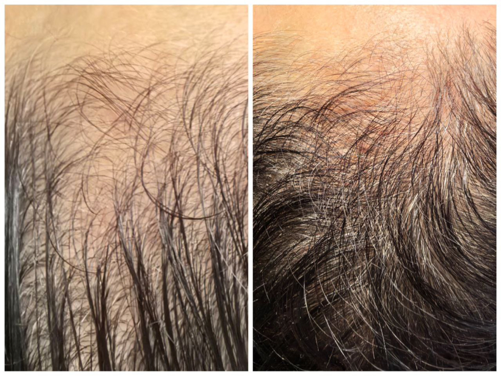 Холодная плазма (волосы)