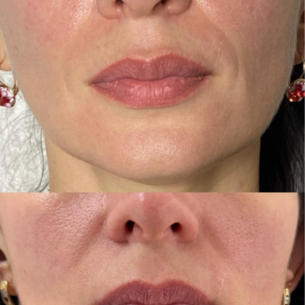 Холодная плазма ( носогубки)