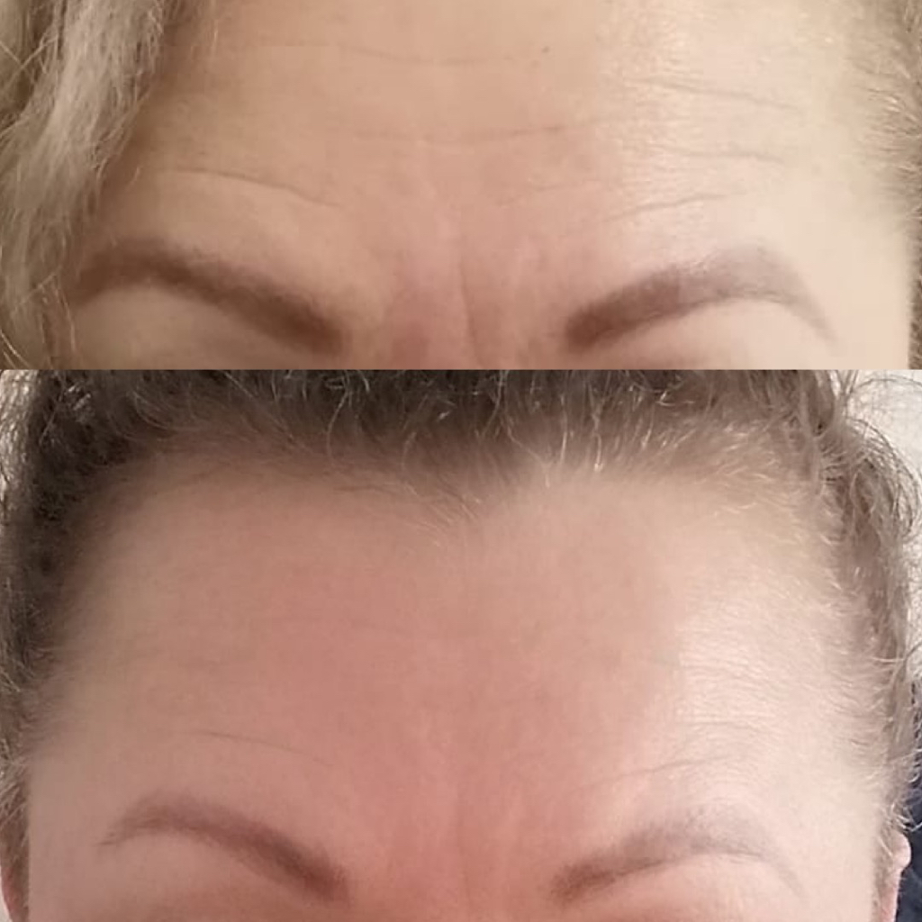 Холодная плазма (лоб)