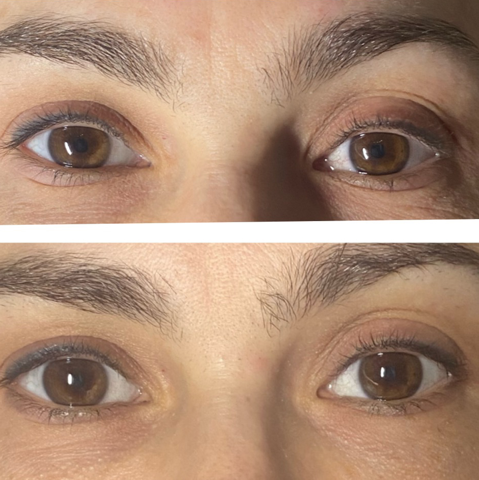 Холодная плазма( блефаропластика верх+низ)