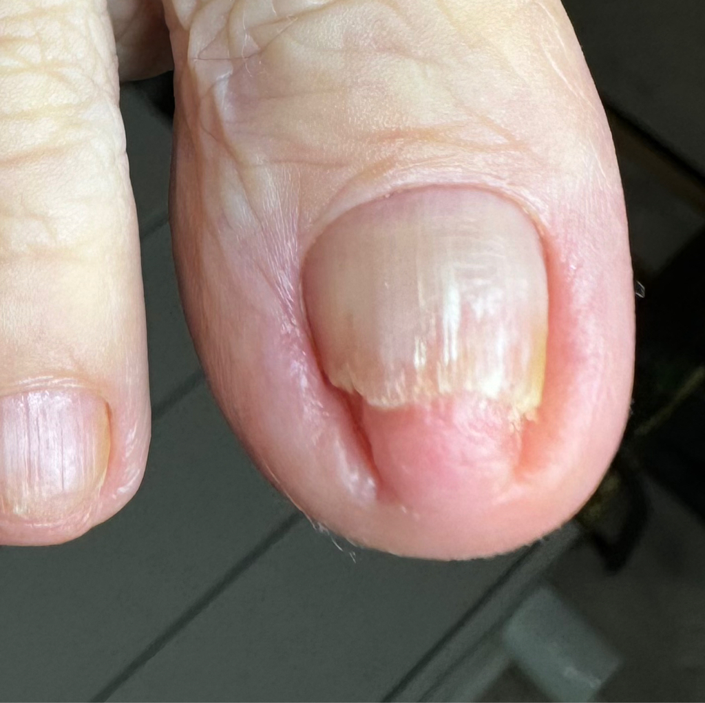 Зачистка микоза на ногтях