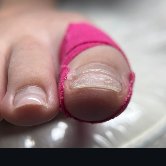 Протезирование ногтя