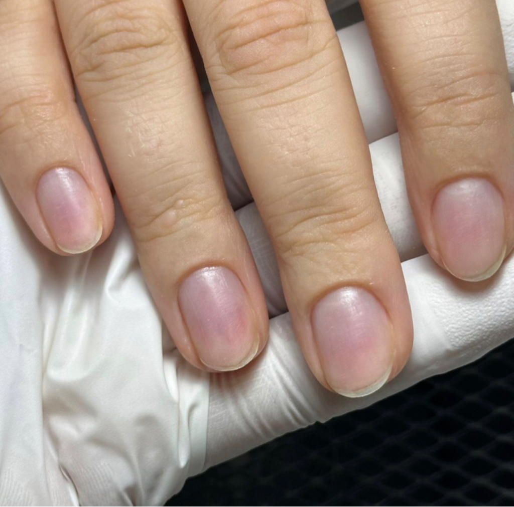 Полное снятие покрытия/наращивания без дальнейших процедур (с опилом формы)