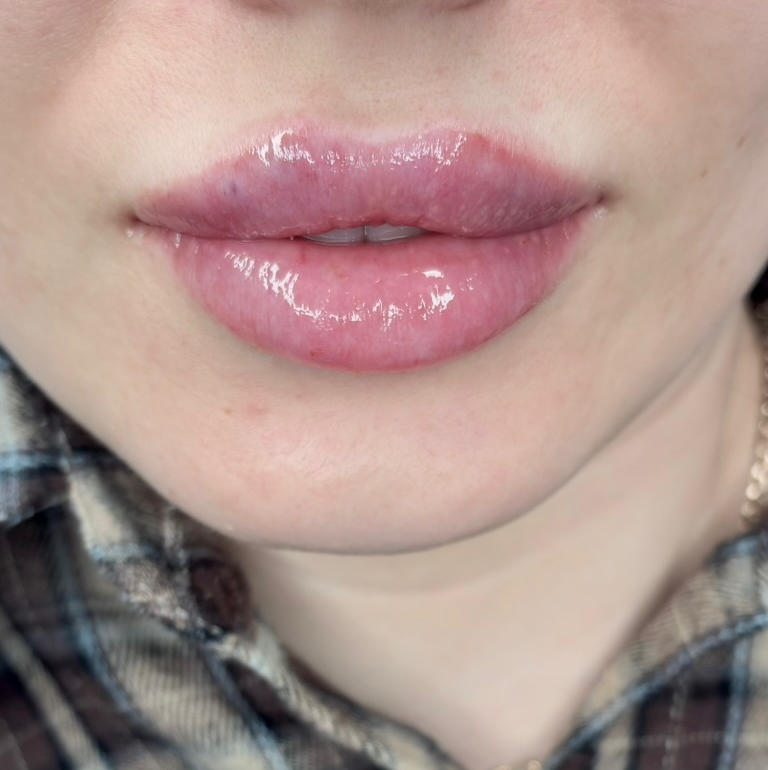 Увеличение губ 0,5мл