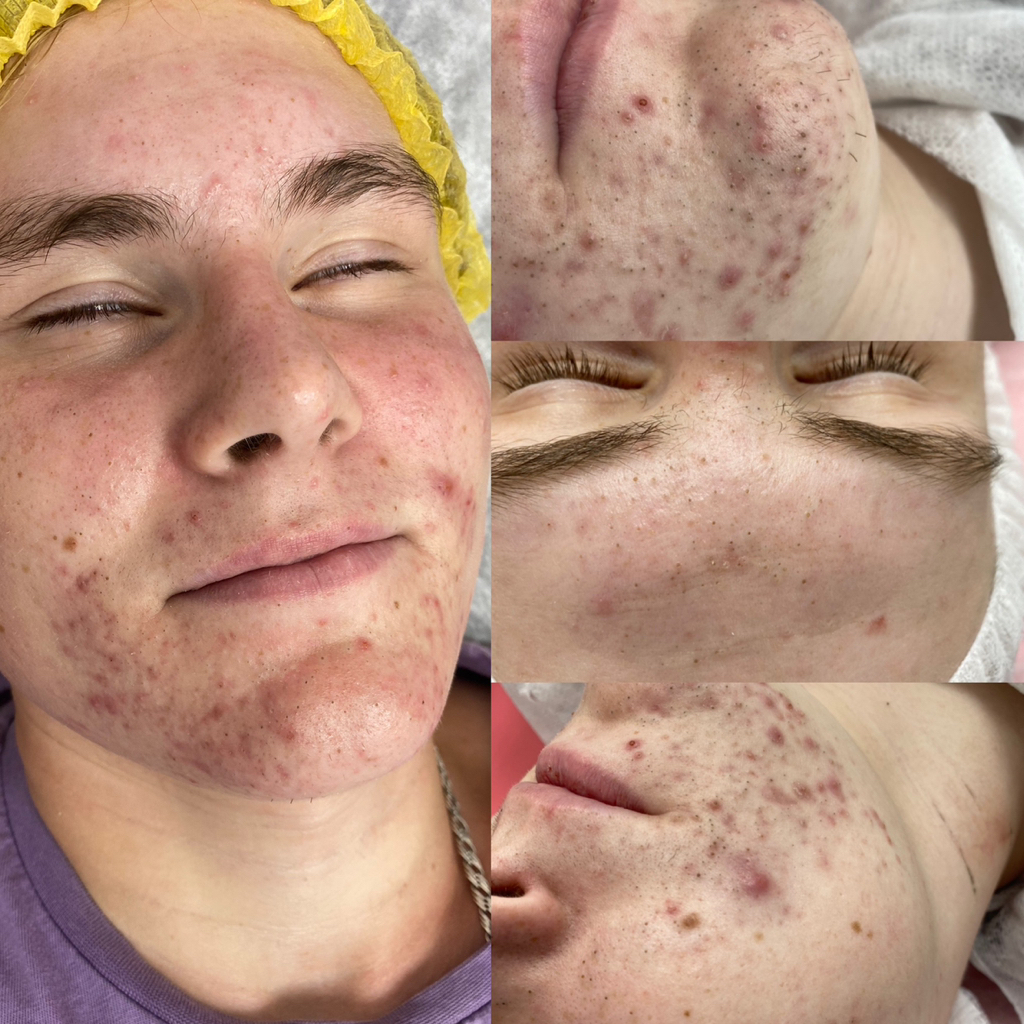 Чистка лица