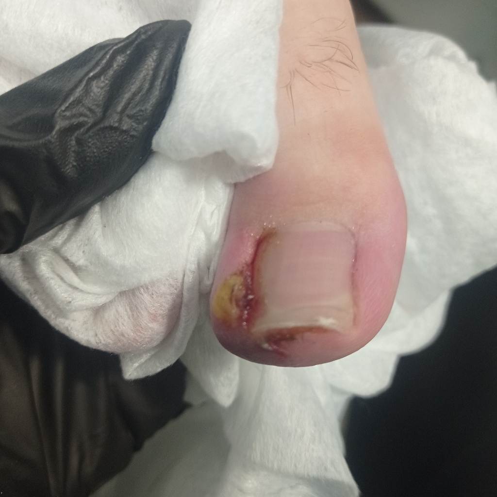 Работа с проблемным ногтем. С признаками воспаления