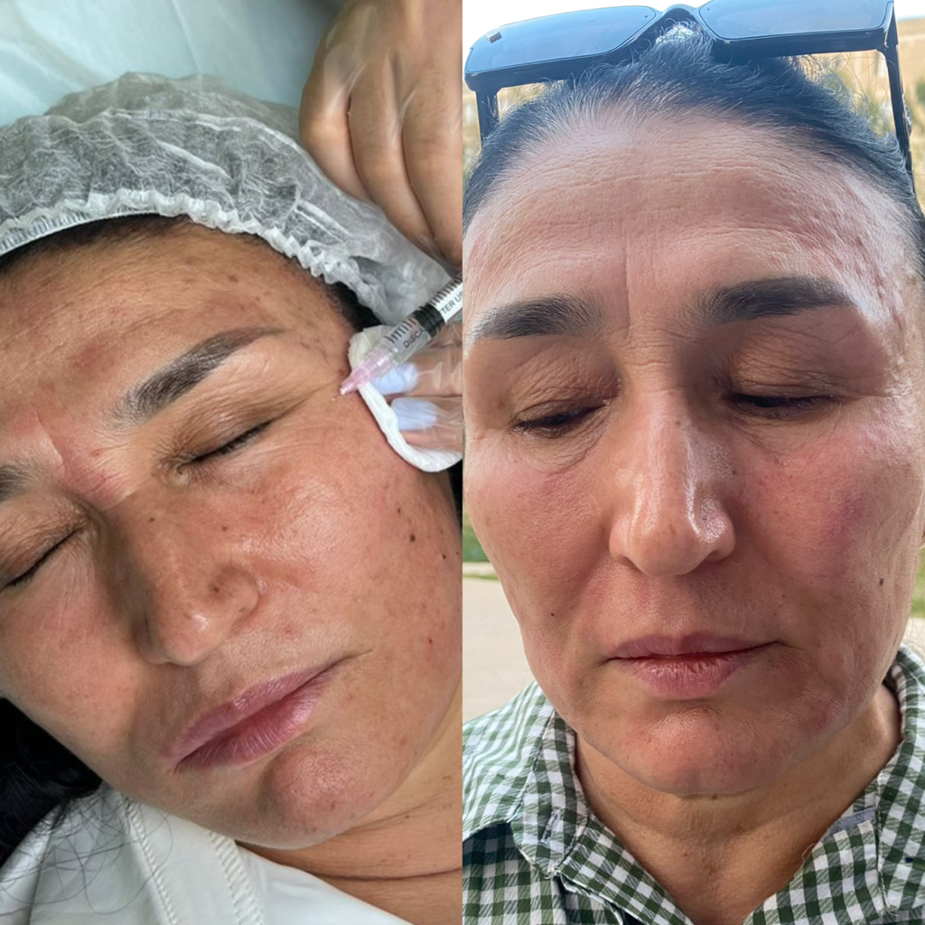 Биоревитализация  манитол invate