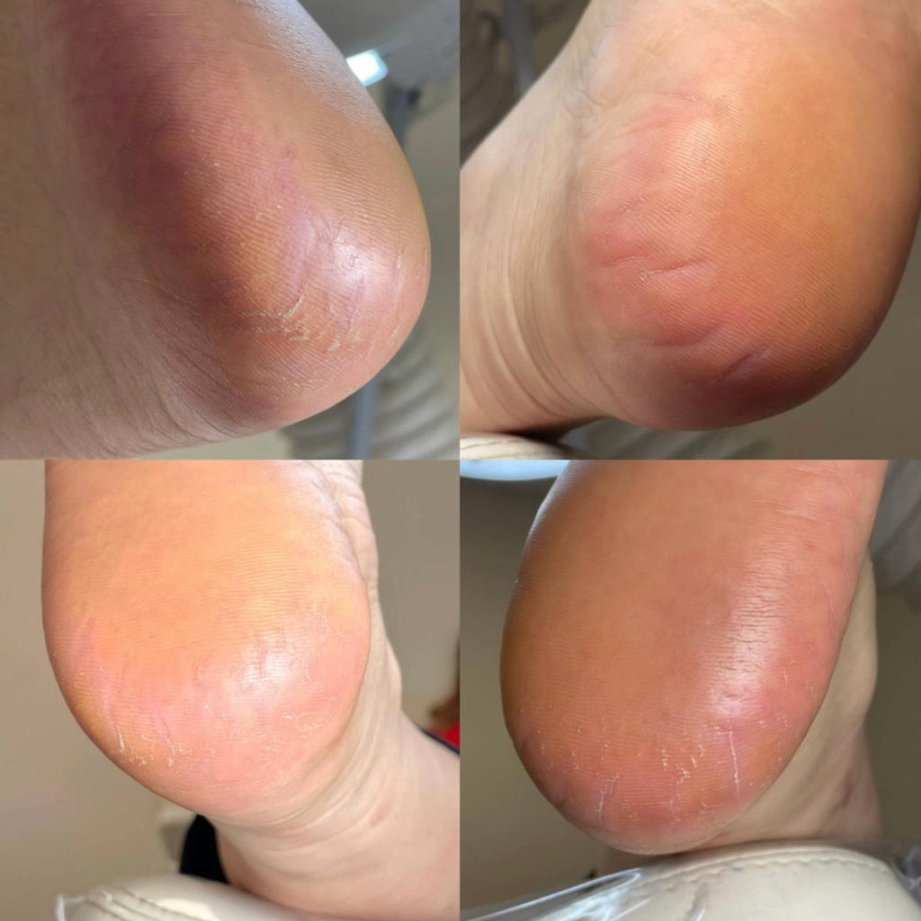 Обработка стоп