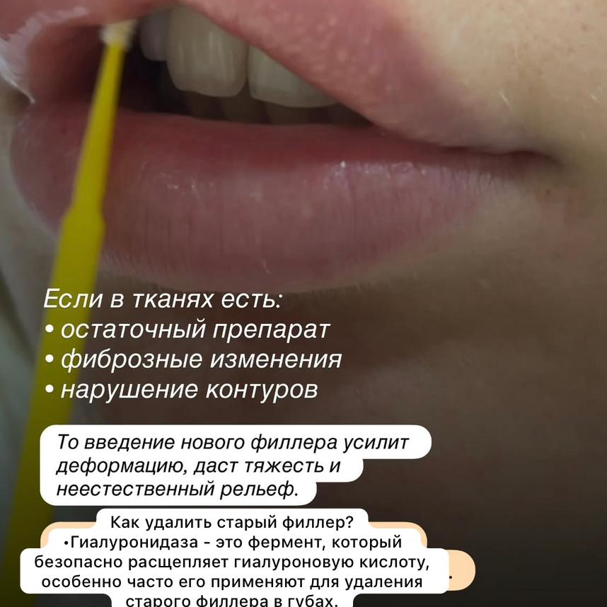 Удаление филлера из губ   Удаление филлера из губ (или области носогубных складок) — это процедура, направленная на выведение препарата, обычно гиалур