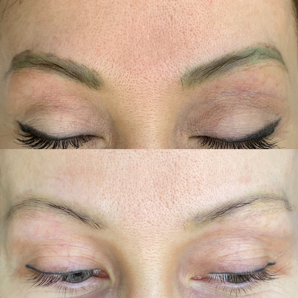 Удаление татуажа бровей ремувером