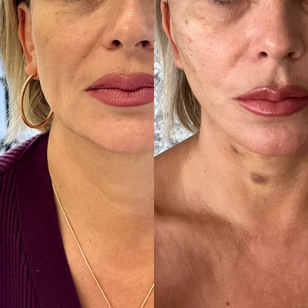 Нитевая подтяжка лица