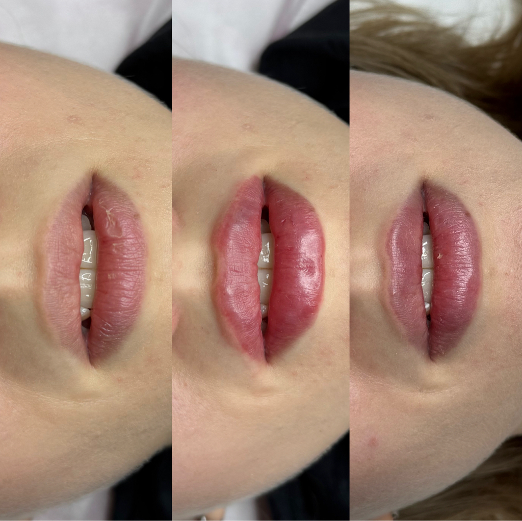 Увеличение губ у доктора Полины