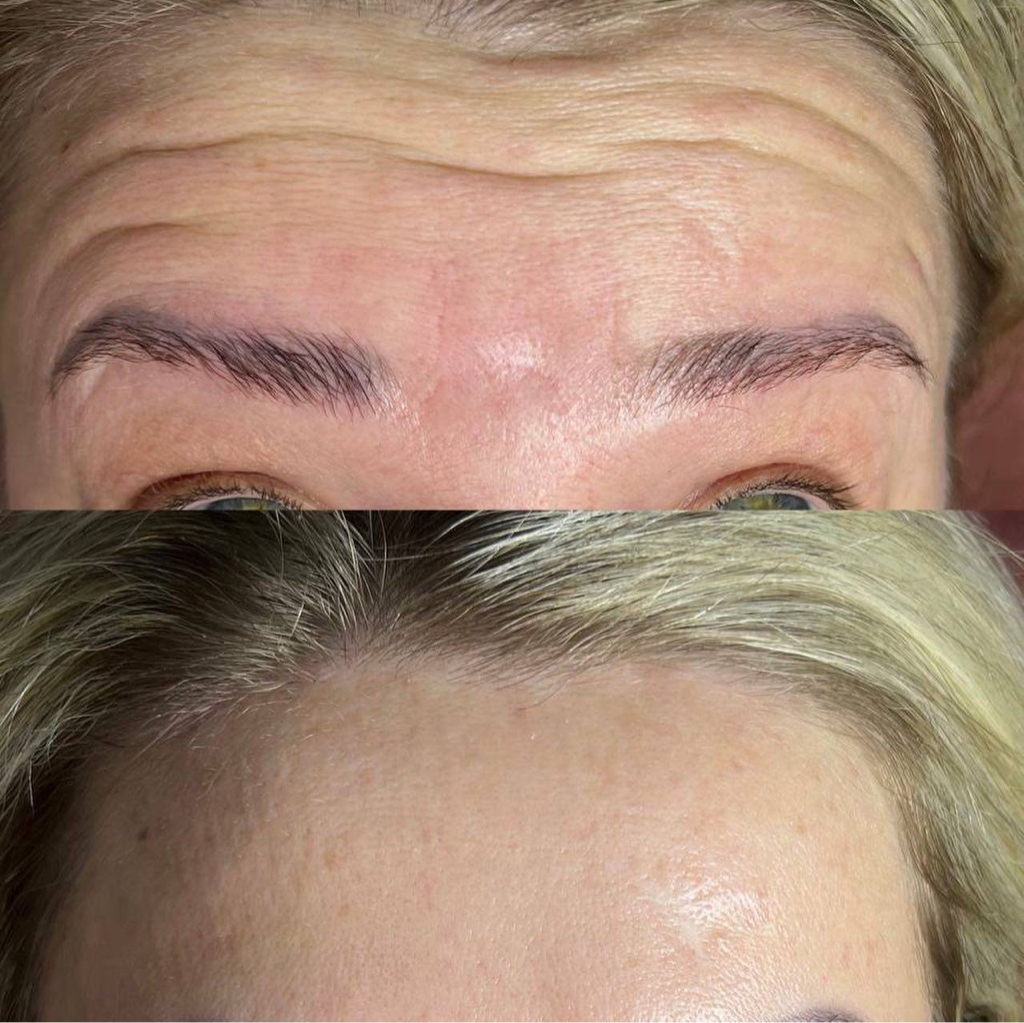 Ботулинотерапия лоб + межбровье