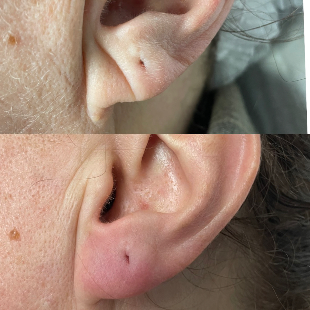 Контурная пластика мочек ушей