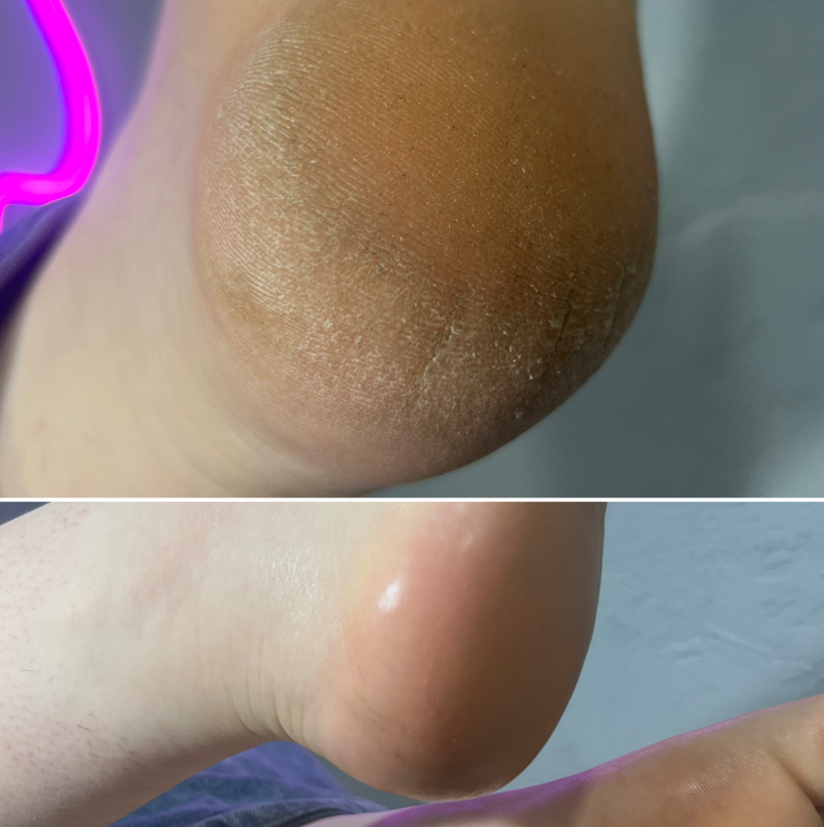 Педикюр (обработка стопы)