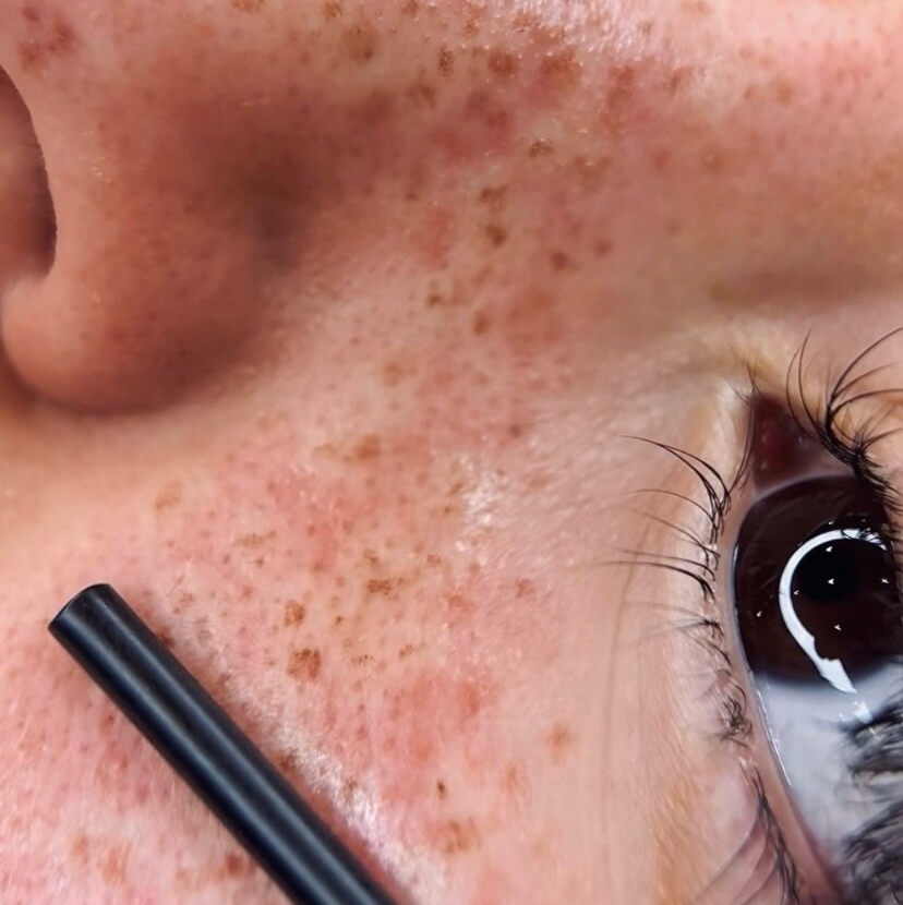 Перманент родинок и веснушек