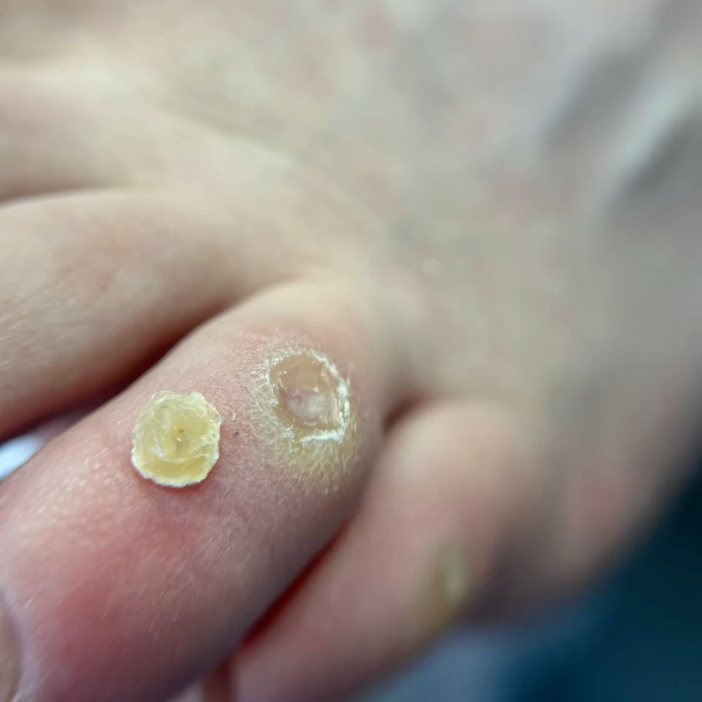 Обработка стержневой, межпальцевой мозоли (1 элемент)