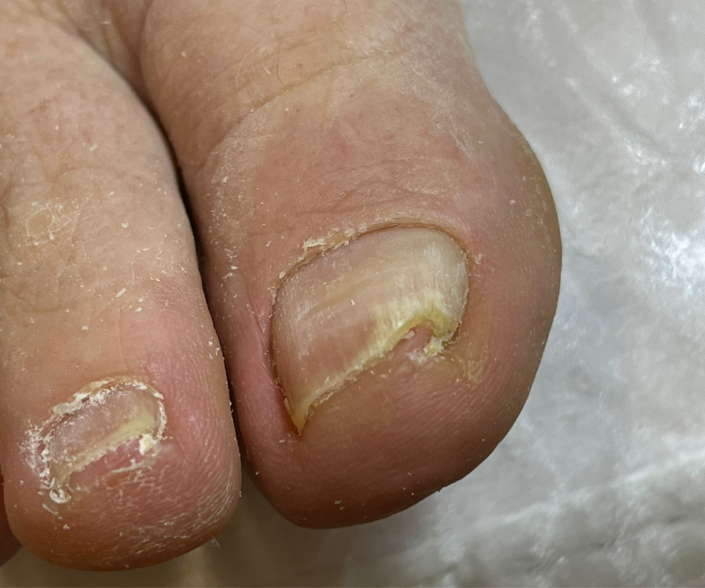 Обработка деформированных и вросших ногтей (1 ноготь)