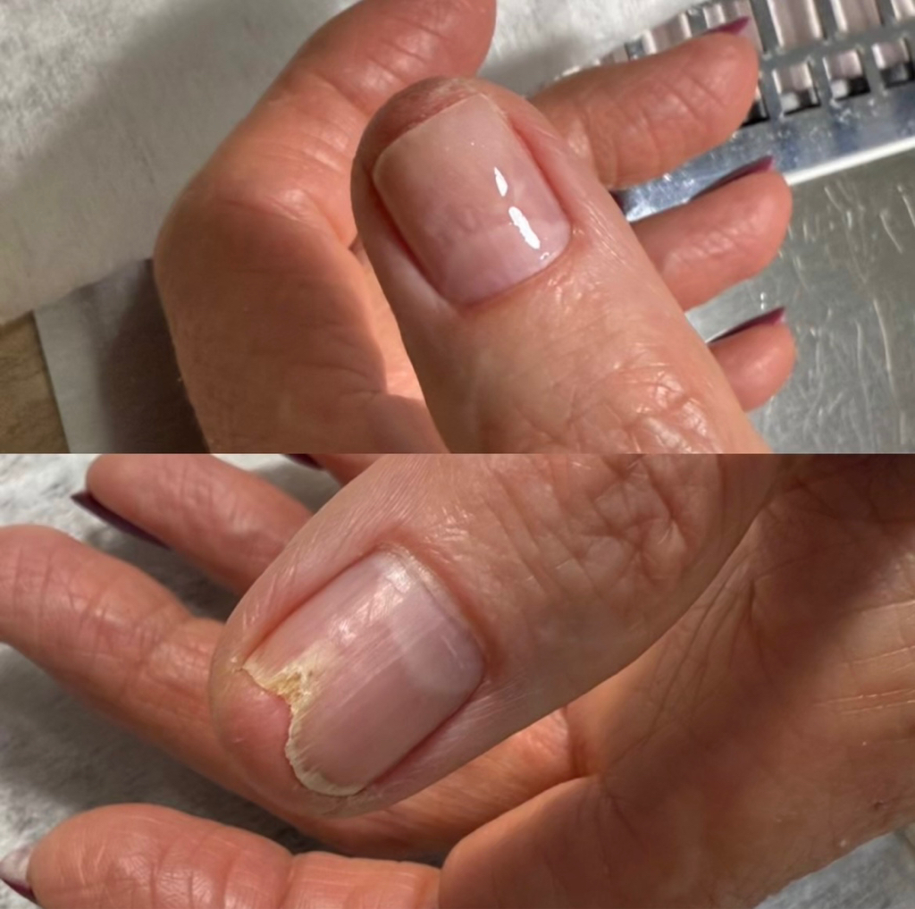 Протезирование