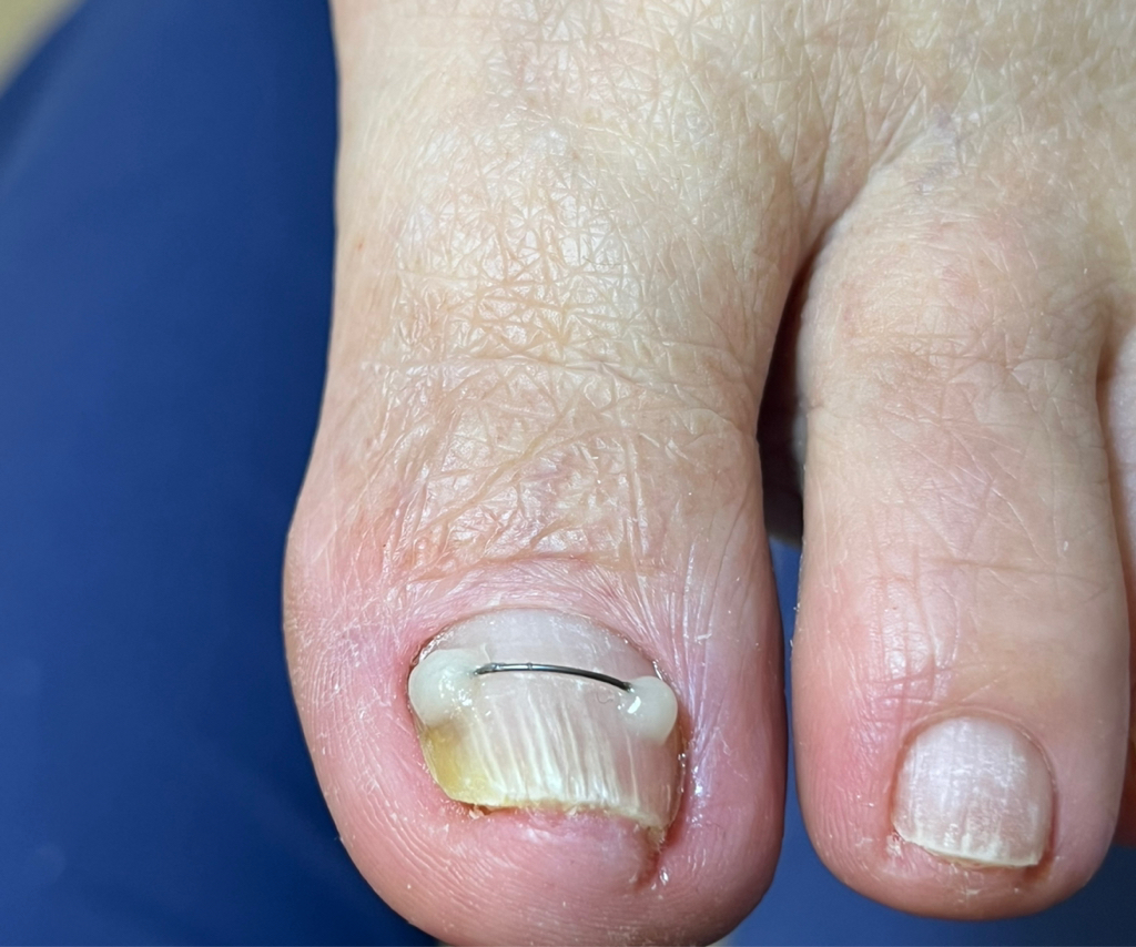 Устранение деформации ногтей (Титановая нить, Лайт система)