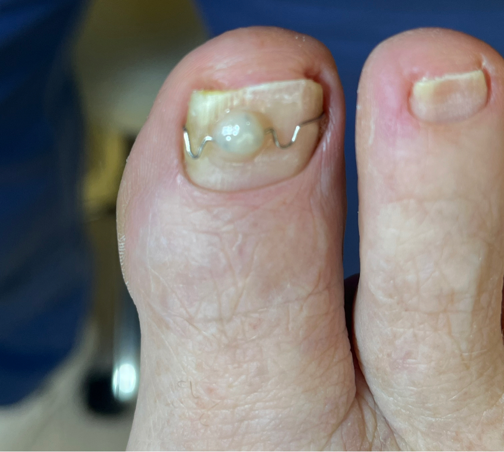 Коррекция (скоба фрезера) 3ТО