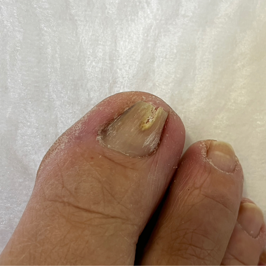 Обработка деформированных ногтей пальцев ног