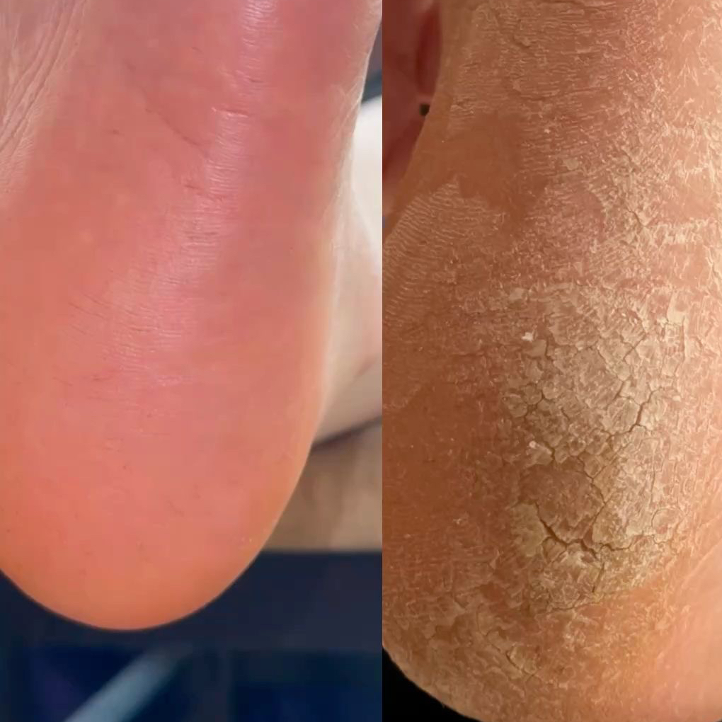 Гигиеническая обработка ступни ног