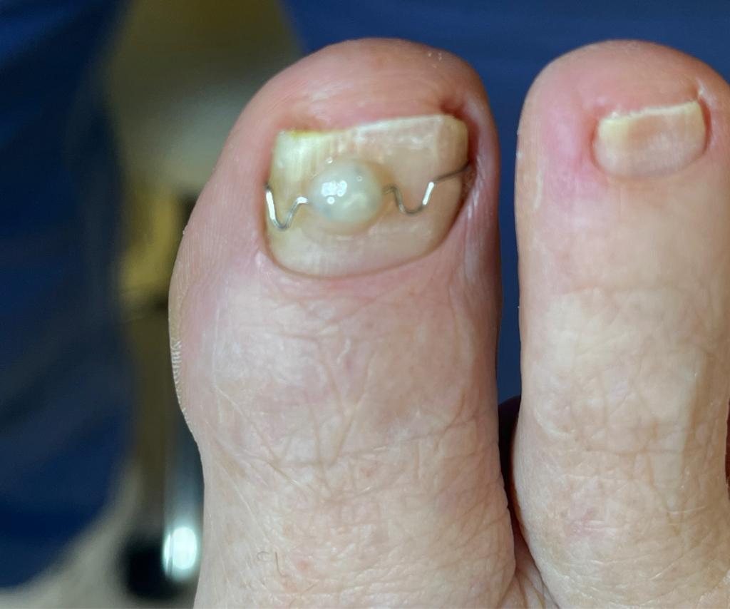 Устранение деформации ногтей (скоба фрезера) 3ТО