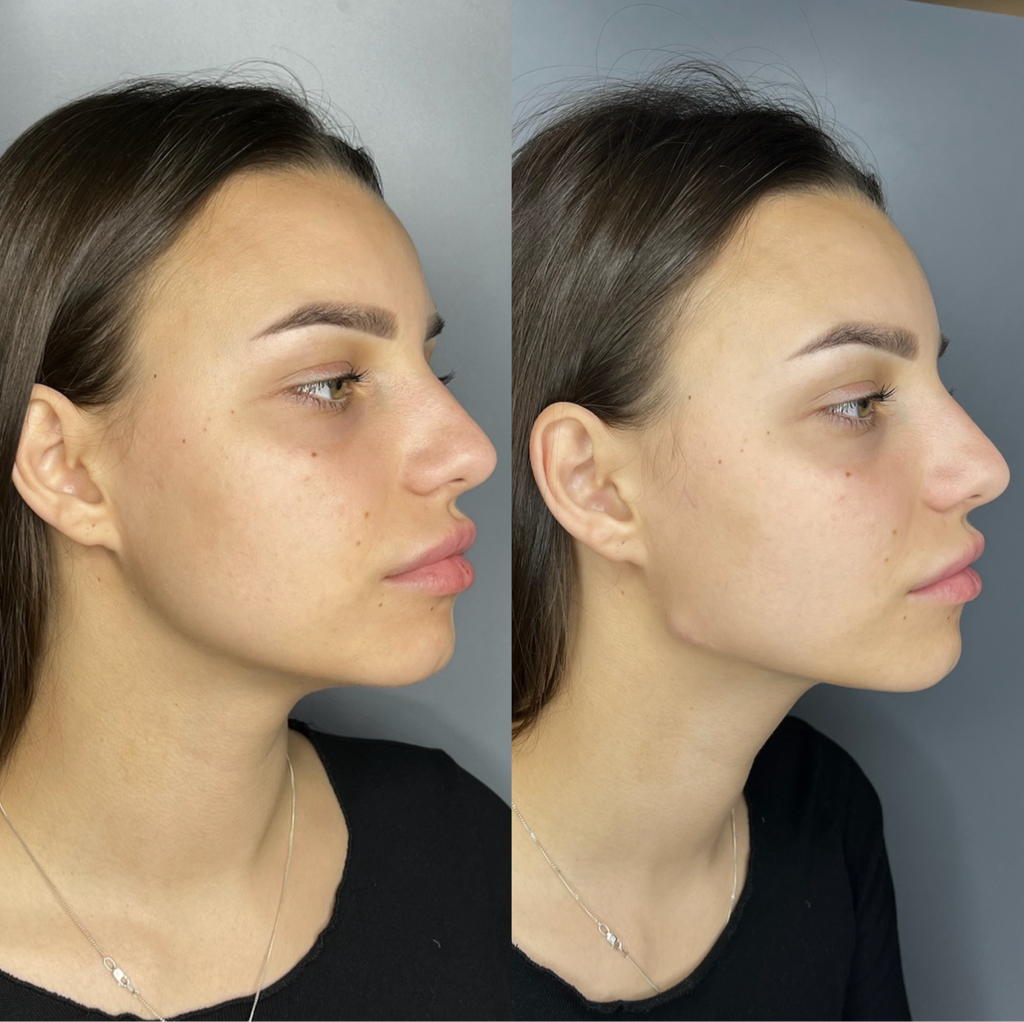 Профиль Джоли (углы нижней челюсти + подбородок)