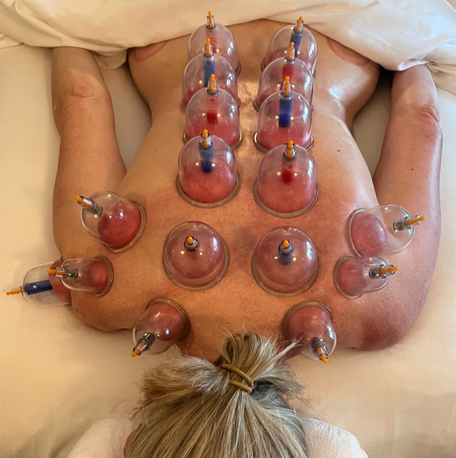 Постановка статичных банок после массажей.