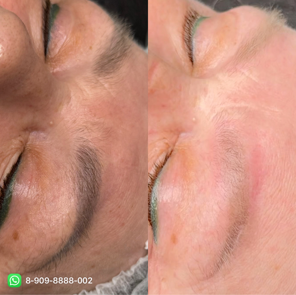 Лазерное Осветление тату/татуажа