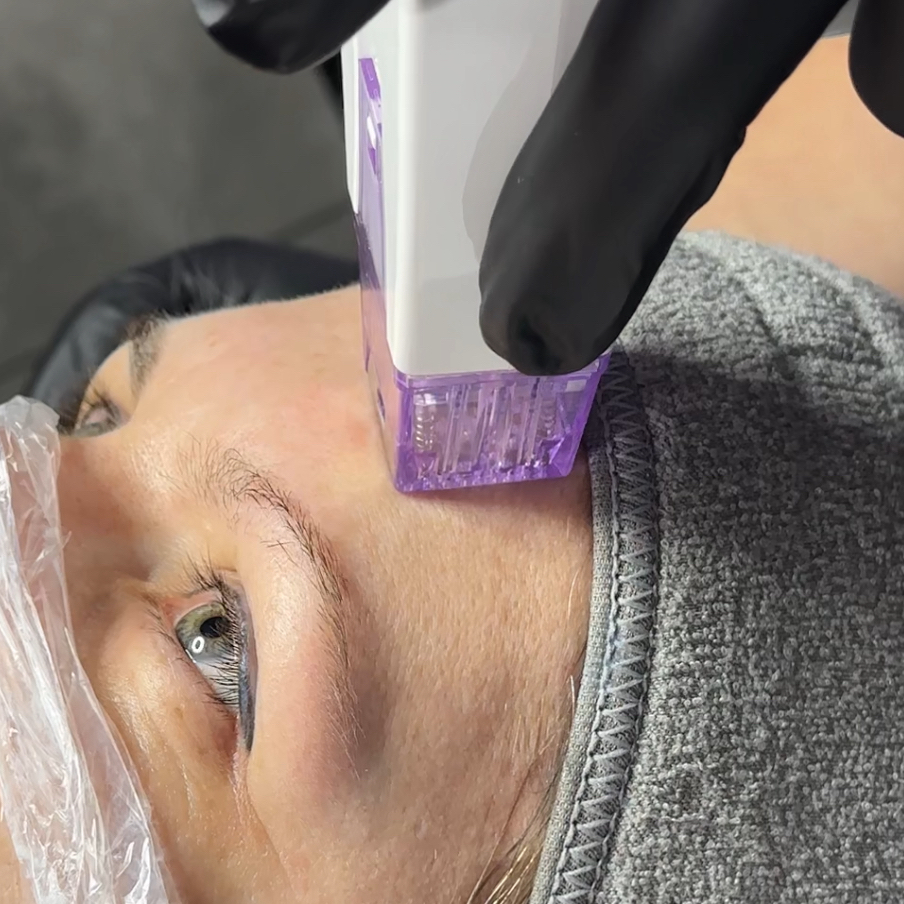 Rf-лифтинг Morpheus 8