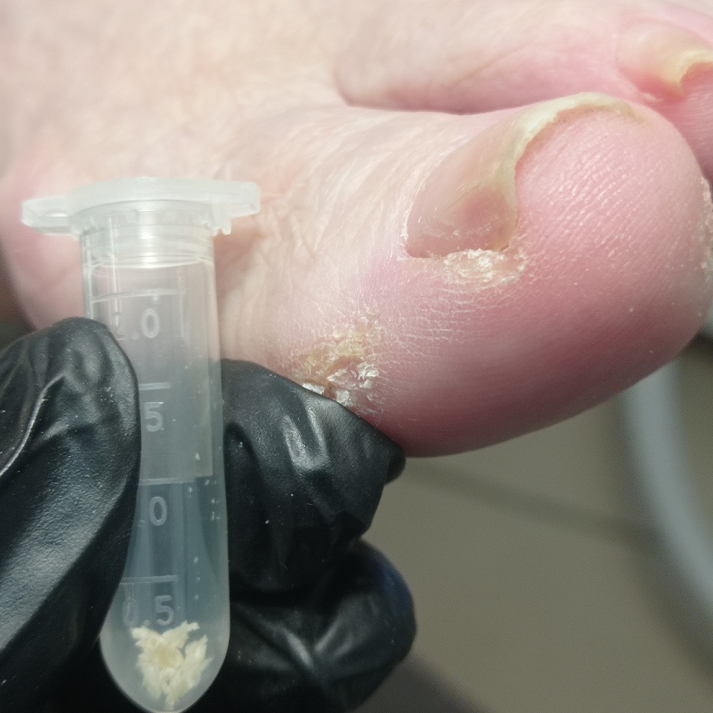 Сбор анализов на грибковое поражение