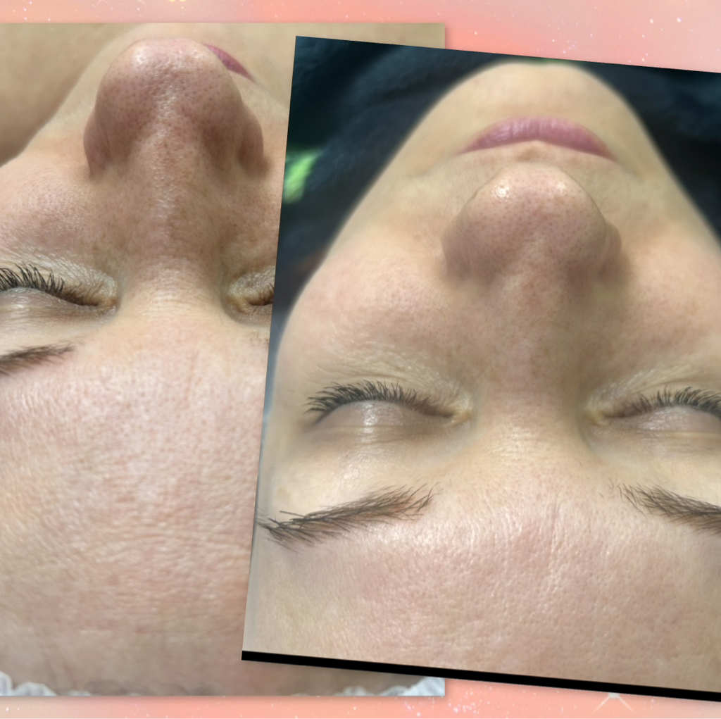 УЗ чистка лица