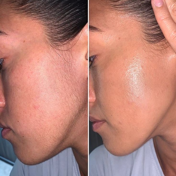 Удаление воском волос на лице !