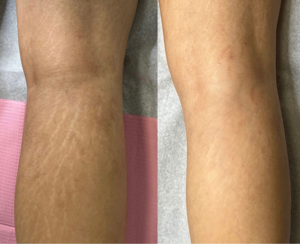 УДАЛЕНИЕ РАСТЯЖЕК ШРАМОВ