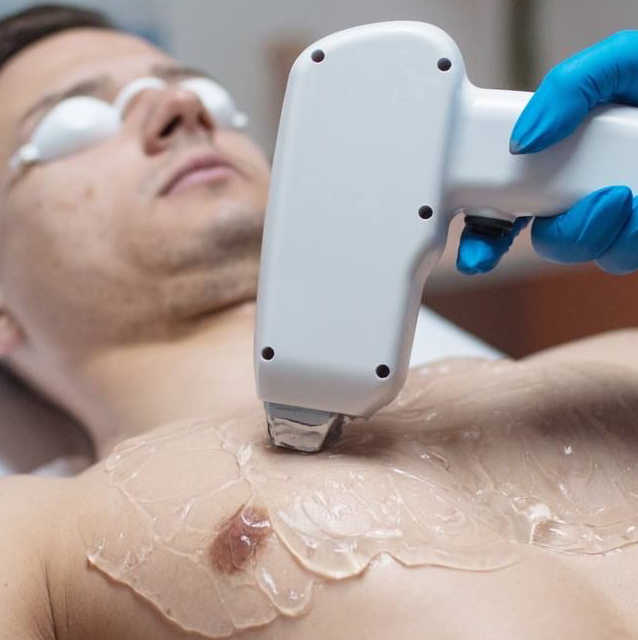 Мужчины лазер живот