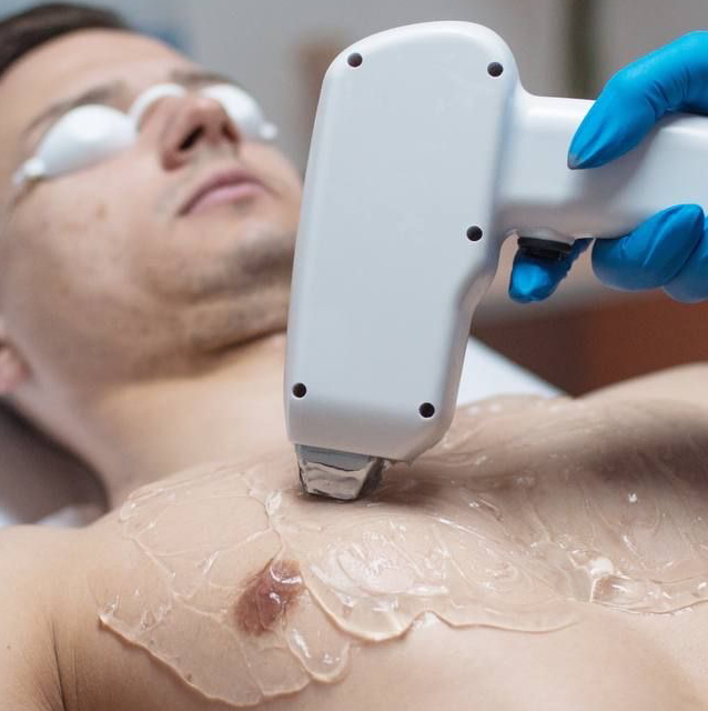 Лазер мужчина - подмышки