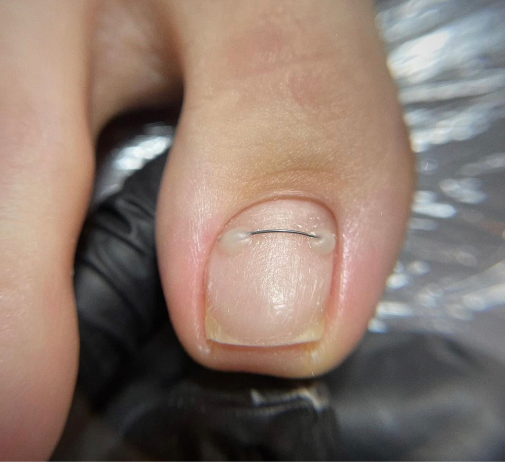 Корректирующая система «титановая нить»